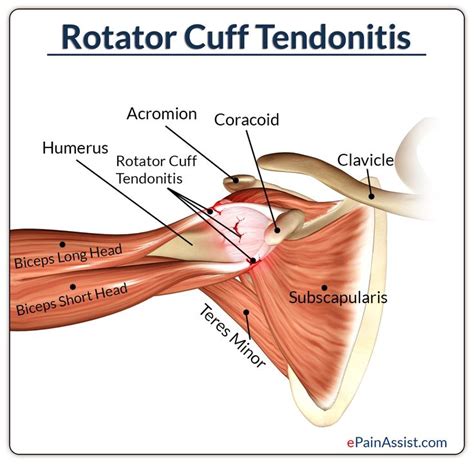 Massage Therapy for Rotator Cuff Tendonitis | Músculos del cuerpo ...