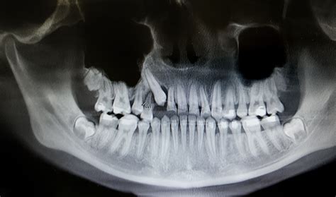 What Is An Impacted Tooth? | How We Can Help You