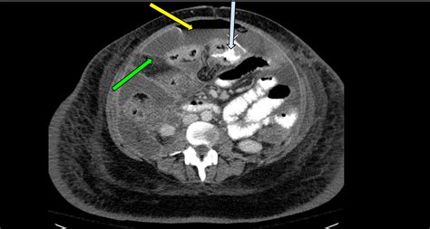 Small Bowel Perforation Caused By Disseminated Mucormycosis | Consultant360