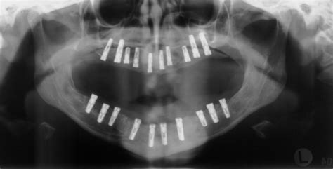 Dentin dysplasia type I: a challenge for treatment with dental implants | Head & Face Medicine ...