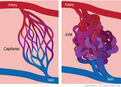 Arteriovenous Malformations (for Parents) - Nemours KidsHealth | Brain diseases, Medical ...