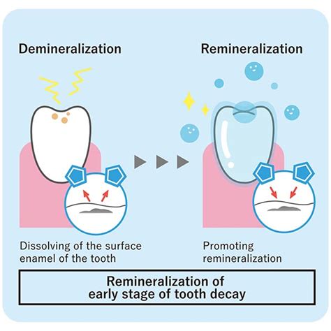 A study on tooth remineralization with a mineral-coated toothbrush ...