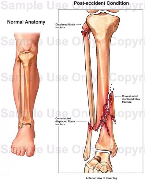 How did that fracture really occur? - Critical Analysis RN Consulting