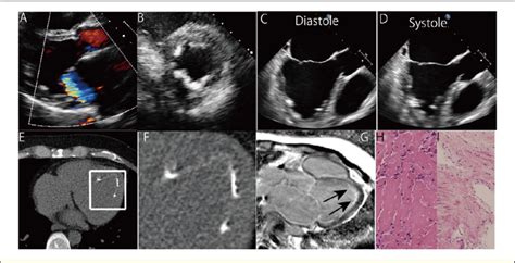 (A,B) Transthoracic echocardiogram (A, substernal long axis view).... | Download Scientific Diagram