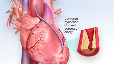 Did Your Doctor Recommended Bypass Surgery?