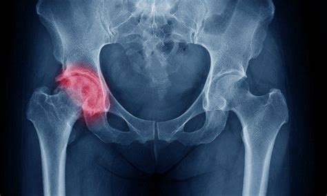 Are video games to blame for fragile bones? | Osteoarthritis, Hip ...