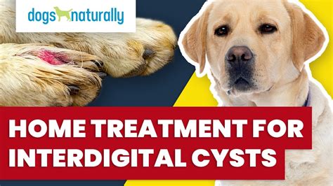 Home Treatment For Interdigital Cysts - YouTube