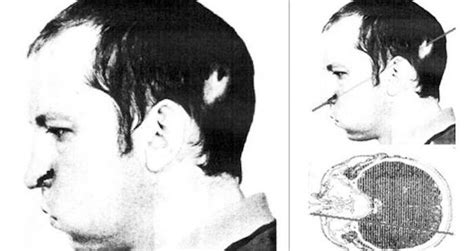 Anatoli Bugorski Was Shot Through The Face With A Laser And Lived