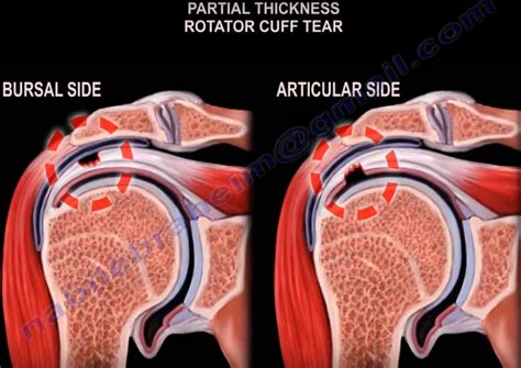 Rotator Cuff Tear Classification — OrthopaedicPrinciples.com