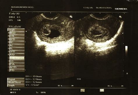 Transvaginal image of a chorionic bump; age of gestation: 5 weeks, 4... | Download Scientific ...