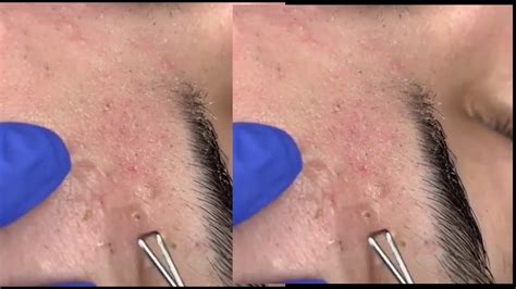 dr pimple popper Blackhead Extraction - YouTube