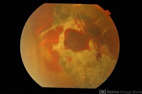 Concussion With Choroidal Rupture - Retina Image Bank