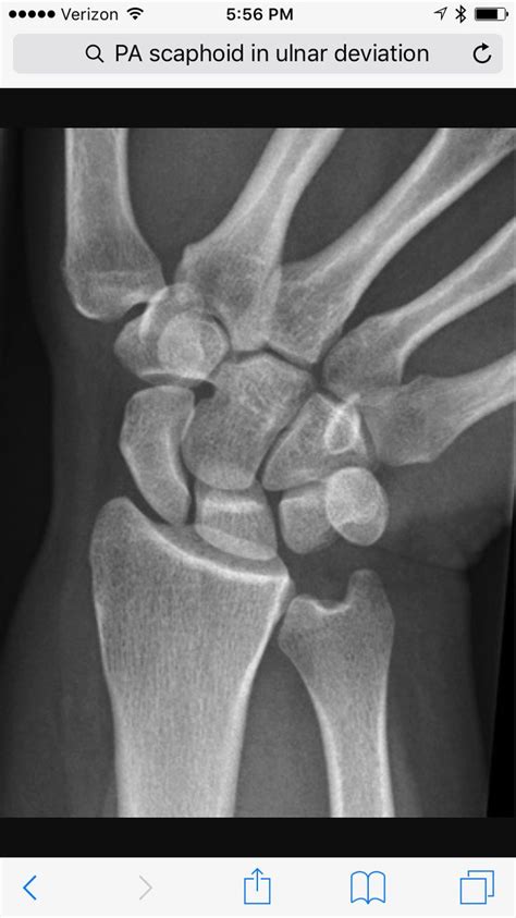 PA Scaphoid in ulnar deviation: 10-20 degree cephalic. Central ray perpendicular to navicular ...