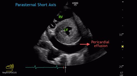 Pericardial Effusion Echo