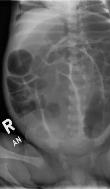 Hirschsprung Disease | Consultant360