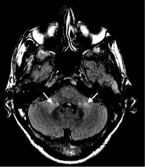 Atypical presentation and diagnosis of AIDS-related CMV encephalitis ...