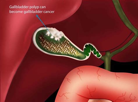 Gallbladder Polyps Ultrasound