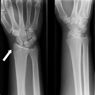 Undisplaced distal radius fracture | CUH