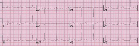 Dr. Smith's ECG Blog: Osborn Waves and Hypothermia