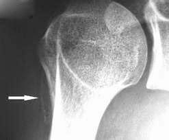 Medical Treatment Pictures-for Better Understanding: Arthroscopic Hip Synovectomy Surgery ...