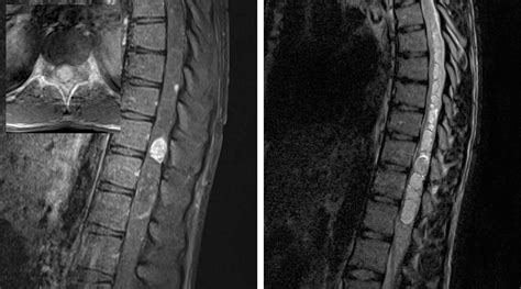 Intramedullary Spinal Cord Tumor | The Neurosurgical Atlas, by Aaron Cohen-Gadol, M.D.