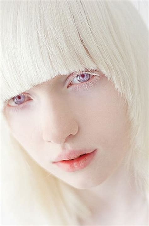 What Color Are Albino Human Eyes