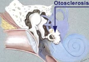 Otosclerosis - Types, Causes, Symptoms, Treatment and Prognosis