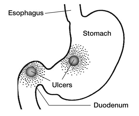 Bleeding ulcer symptoms you need to know