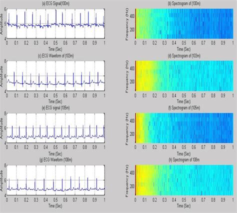 ECG signal plot and spectrogram analysis a ECG signal of 100 m database ...