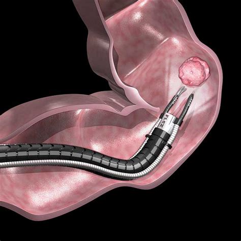 Johns Hopkins Among First to Offer Flexible Robotic Endoscopy