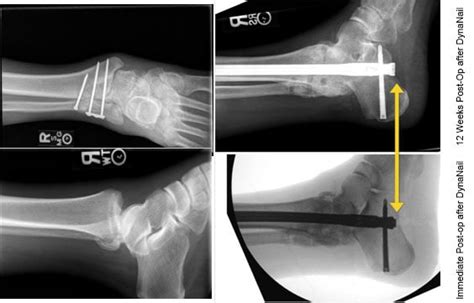 What are the Stages of Charcot foot? - MedShape, Inc.