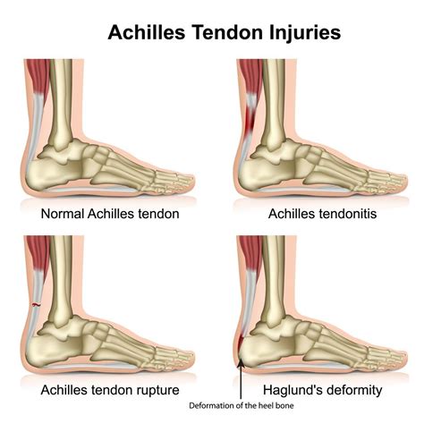 What Are The Signs of a Torn Achilles Tendon?