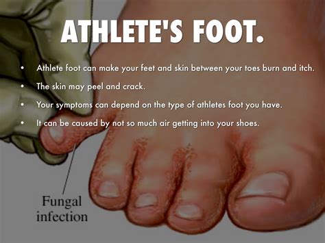 athletes foot fungus between toes athlete s foot by daunte mills