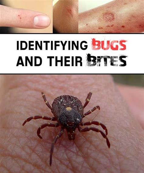 Pin on Bug Bite Remedies