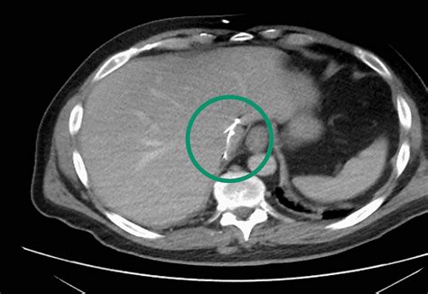 Migration of an Inferior Vena Cava (IVC) Filter Into the Intrahepatic IVC: A Case Report | Cureus