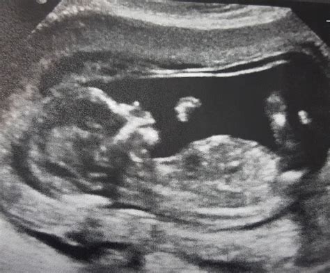 13 Week Ultrasound Boy Or Girl | Images and Photos finder