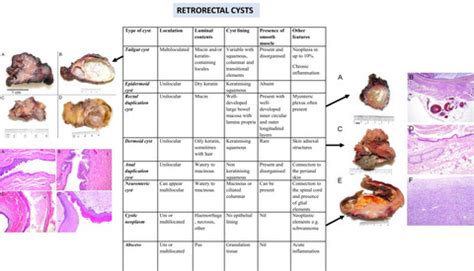 Cystic lesions of the retrorectal space - Brown - 2023 - Histopathology - Wiley Online Library