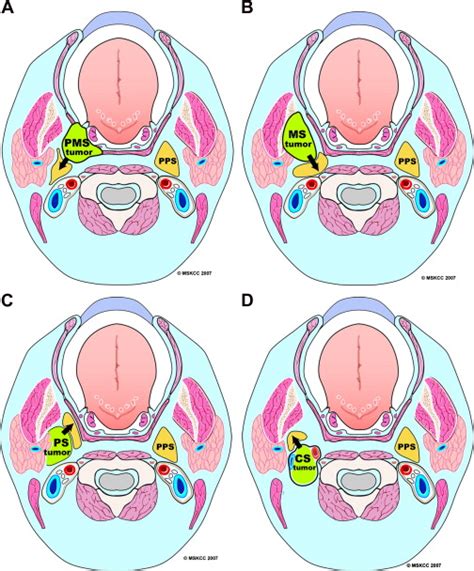 Imaging of the Parapharyngeal Space | Ento Key