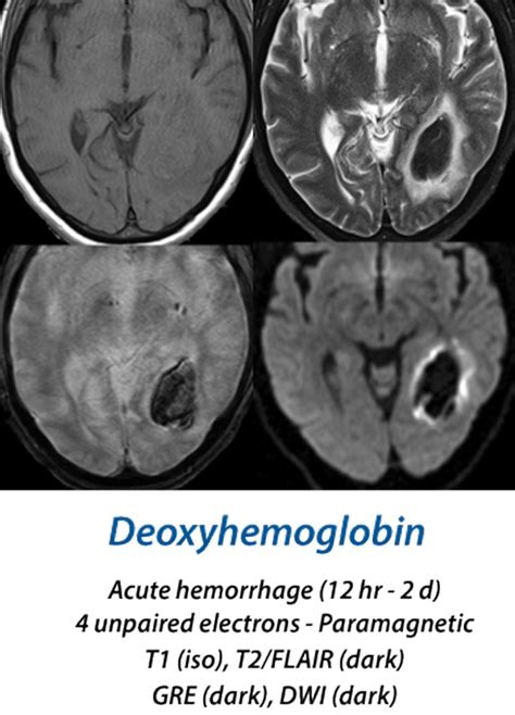 Hematoma overview MRI - Questions and Answers in MRI