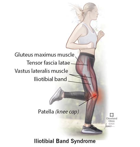 Iliotibial Band Syndrome (ITBS): Causes, Symptoms & Treatment