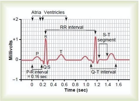 Traçado De Ecg Normal