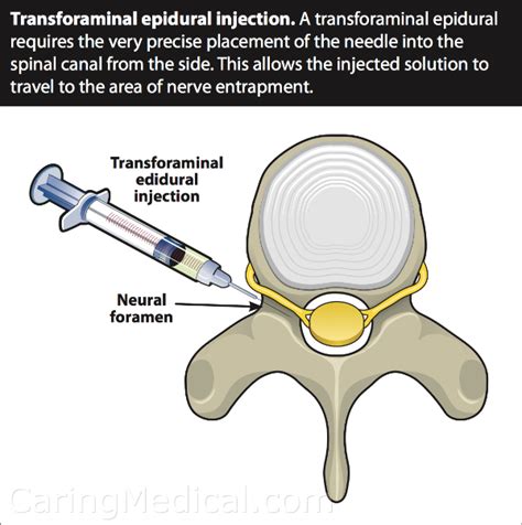 Spinal Epidural Steroid Injection