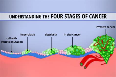 4 Stages Of Cancer - Increased Insight