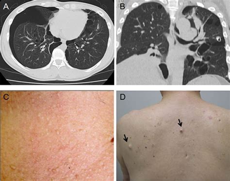 Birt-Hogg-Dube syndrome causes, symptoms, diagnosis & treatment