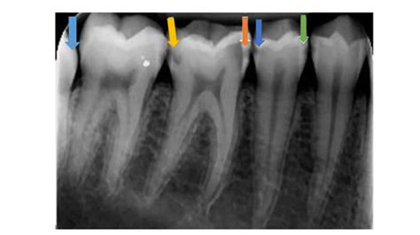 caries classification system