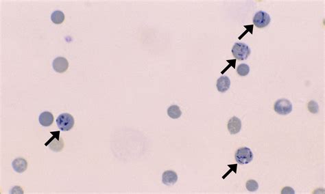 Reticulocytes – Cells and Smears