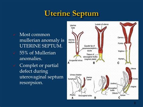 PPT - HYSTEROSCOPIC SEPTUM RESECTION PowerPoint Presentation - ID:4681029