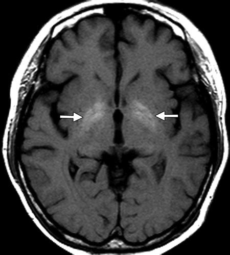 Differential Diagnosis for Bilateral Abnormalities of the Basal Ganglia ...