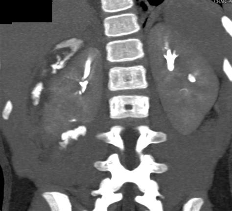 Right Renal Laceration with Multiple Phases. Delayed Phase Nicely Shows ...