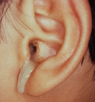 How to Deal with Ear Discharge « Know your body :: WonderHowTo